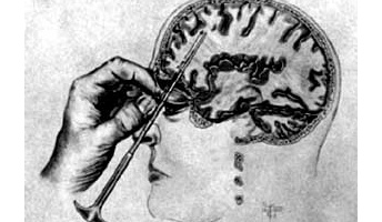 【閲覧注意】昔の人「せや、脳にアイスピック突っ込んでグリグリすれば・・・」→結果・・・・