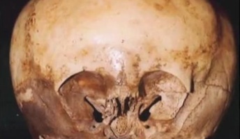 メキシコで見つかった頭蓋骨 ミトコンドリアDNAが人類とまったく違うエイリアンのものと判明