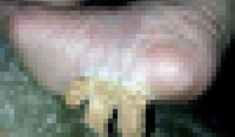 【閲覧注意】サウジ・アラビアの女性の足の裏から変な物体がニョキニョキと生える