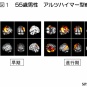 脳卒中にならないためのリハビリテーション⑥　安静時の脳血流低下はCVD発症の危険因子(Stroke. 2012; 43: 1542-1547)