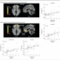 アルコール依存者のデフォルト・モード・ネットワーク～JAMA Psychiatry Published online May 1, 2013