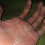 俺の手がマジでキモいんだがこれなんの病気なの？