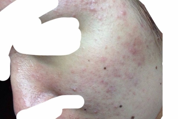 ミラクル汚肌代olのクロロフィル体験記 ニキビ