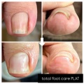 巻き爪補正症例