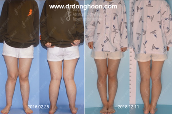 曲がった脚 X脚矯正の手術前後の写真 Dr Donghoonのブログ