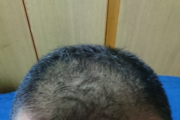 ハゲ坊主のブログ ミノキシジルタブレット フィンペシアorデュタス 亜鉛 L リジン Aga 18年05月