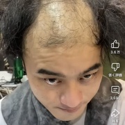 【画像】カリスマ美容師、ハゲを救済してしまうwwwwwwwwwww
