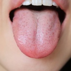 【警告】日本の若者に『舌癌』が激増 → 理由がこれらしい…