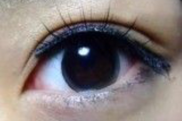 自力で二重まぶたにする方法まとめ 二重整形 まとめ