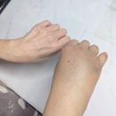 ギブスを外すと治ってると思っていた💦手の記録動画