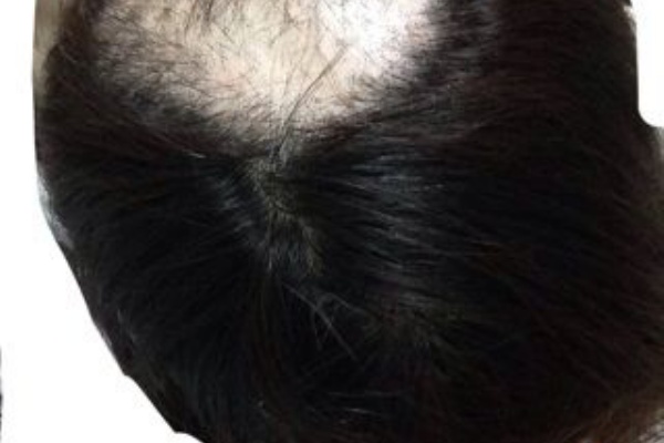 抜毛症と向き合う女 抜毛症