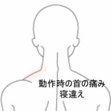 『起床時から左肩首がツーンと突っ張る寝違い 登別室蘭すのさき鍼灸整骨院 症例報告』の画像