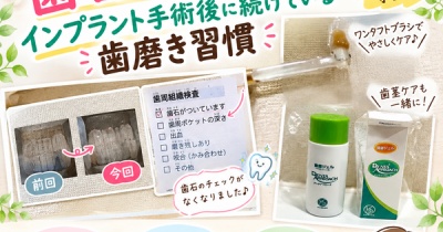 【歯医者の定期健診】歯石が減った！インプラント手術後に続けている歯磨き習慣