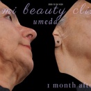 Densityでフェイスラインピタッ＊デンシティの1か月後