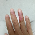 ヤケドのケガの経過観察7※途中患部の写真もあるので閲覧にはご注意下さいませ。