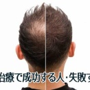 【悲報】ワイちゃん、AGA治療を決意ｗｗｗｗｗｗｗｗｗｗ