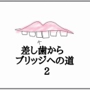 差し歯からブリッジへの道2
