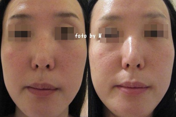 Tbc 毛穴エステ フェイシャルコース 体験3000円 5000円に行った感想 キャビテーション 体験 はしごした口コミ ビフォーアフター写真あり