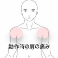 バスの荷物積み下ろしでズキンと痛む両肩の痛み　登別室蘭すのさき鍼灸整骨院　症例報告