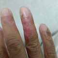 ヤケドのケガの経過観察7※途中患部の写真もあるので閲覧にはご注意下さいませ。