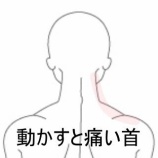『寝違えによる頸部痛と腕の放散痛 登別室蘭すのさき鍼灸整骨院 症例報告』の画像
