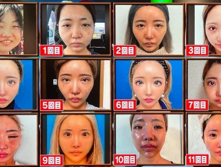 【画像】11回整形した姉ちゃん、12回目で究極の美を手に入れる