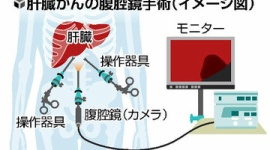 腹腔鏡を使った肝臓手術を受けた100人のうち8人が死亡、いずれも同じ医師…群馬大学病院