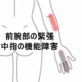 午後になると字が書けなくなる右前腕部の緊張とこわばり 　登別室蘭すのさき鍼灸整骨院　症例報告