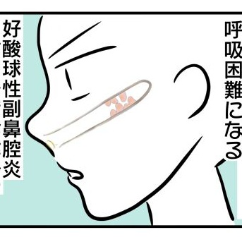 【好酸球性副鼻腔炎】病名が判明すると色々腑に落ちる事【あるある】
