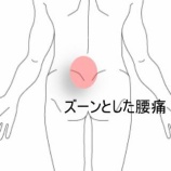 『運動後に増す腰のズーン痛  登別室蘭すのさき鍼灸整骨院　症例報告』の画像