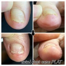 巻き爪補正症例