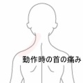 むち打ち後の左頸部痛と動作制限　登別室蘭すのさき鍼灸整骨院　症例報告