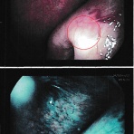 気まぐれkimokuの癌(上咽頭癌)闘病記