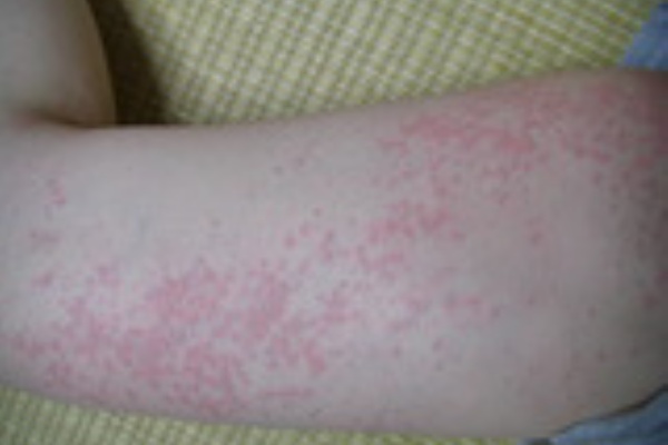 コリン性蕁麻疹 コリン性蕁麻疹