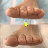 『【実例写真】巻き爪・肥厚爪・白癬爪のケアに悩む方へ』の画像