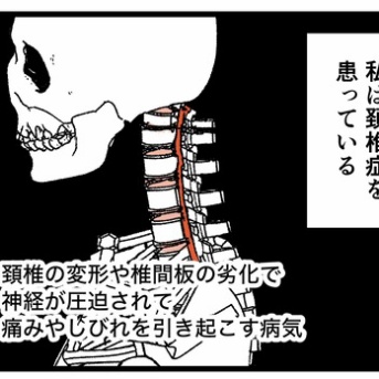 頚椎症を患っているのだが…