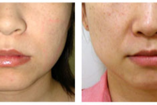 元玉川田島クリニック院長 田島基嗣のブログ 脂肪溶解注射