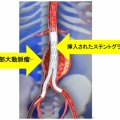 腹部大動脈瘤(りゅう)破裂で友人が突然死!そして私も!