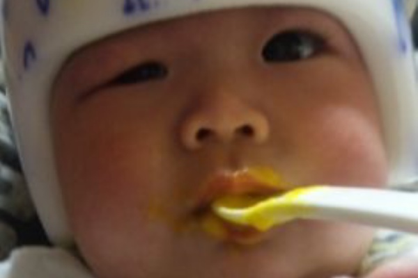 まんまるあたま 変形性斜頭症