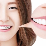 『【ALGN】歯列矯正の革命児!透明で目立たない、取り外し可能で食べたいものが食べられる、金属アレルギーを引き起こす心配なしと世界中で大ヒットしたインビザラインとは。』の画像