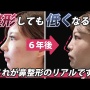 【画像】女子「鼻を整形してキレイになった！」パシャッ　→　6年後、絶望の姿に……