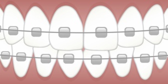 嫁が息子の歯列矯正をしたいと言ってきたんだけど、その費用を検索してビビった…世の中の親は子供にマジでこんな大金払ってるの？