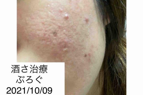 酒さ治療ぶろぐ始めました 酒さ 酒さ治療ぶろぐ始めました 酒さ