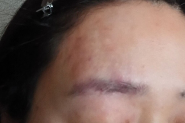 単純性血管腫」治療ブログ