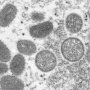 WHO「世界各国でサル痘患者が増えまくっている・・・極めて異常だ」