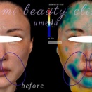 ぽにょりんでほうれい線＆マリオネットラインの改善