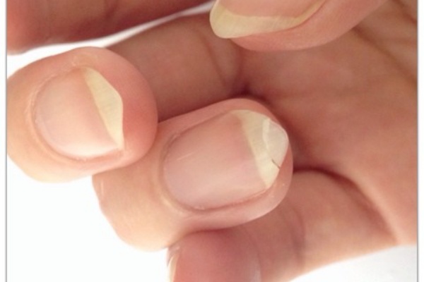 折れた爪を修復 追記有り オッサン ヘタのよこずき