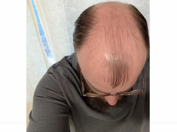 外国人「僕はもうスキンヘッドにする頃合いだろうか？」