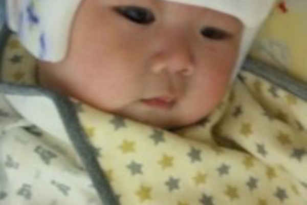 まんまるあたま 変形性斜頭症