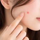 春に気をつけたいニキビ対策｜生活習慣・食事・スキンケアで予防